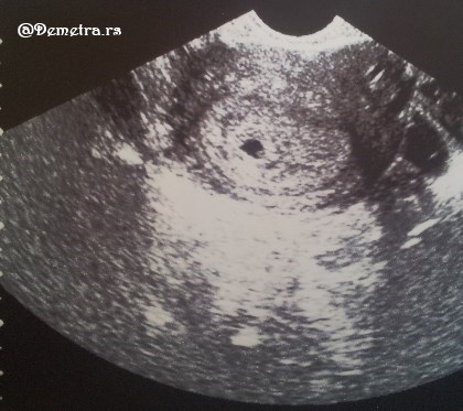 5 nedelja trudnoce ultrazvuk
